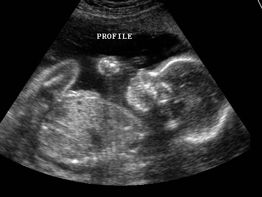 Nation’s Sodomites Under Threat As Expecting Parents Abort Homosexual Fetuses