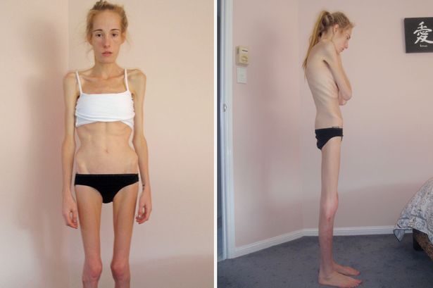 How Female Celebrities Are Responsible For Eating Disorders And Body Image Problems