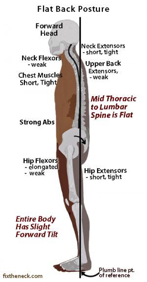 Why You Likely Have Bad Posture