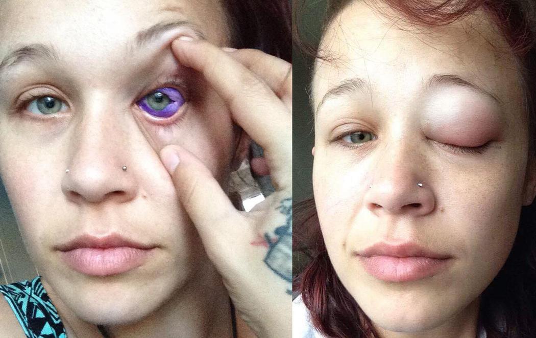 “Model” Lets Boyfriend Of One Month Tattoo Her Eyeball, May Go Blind